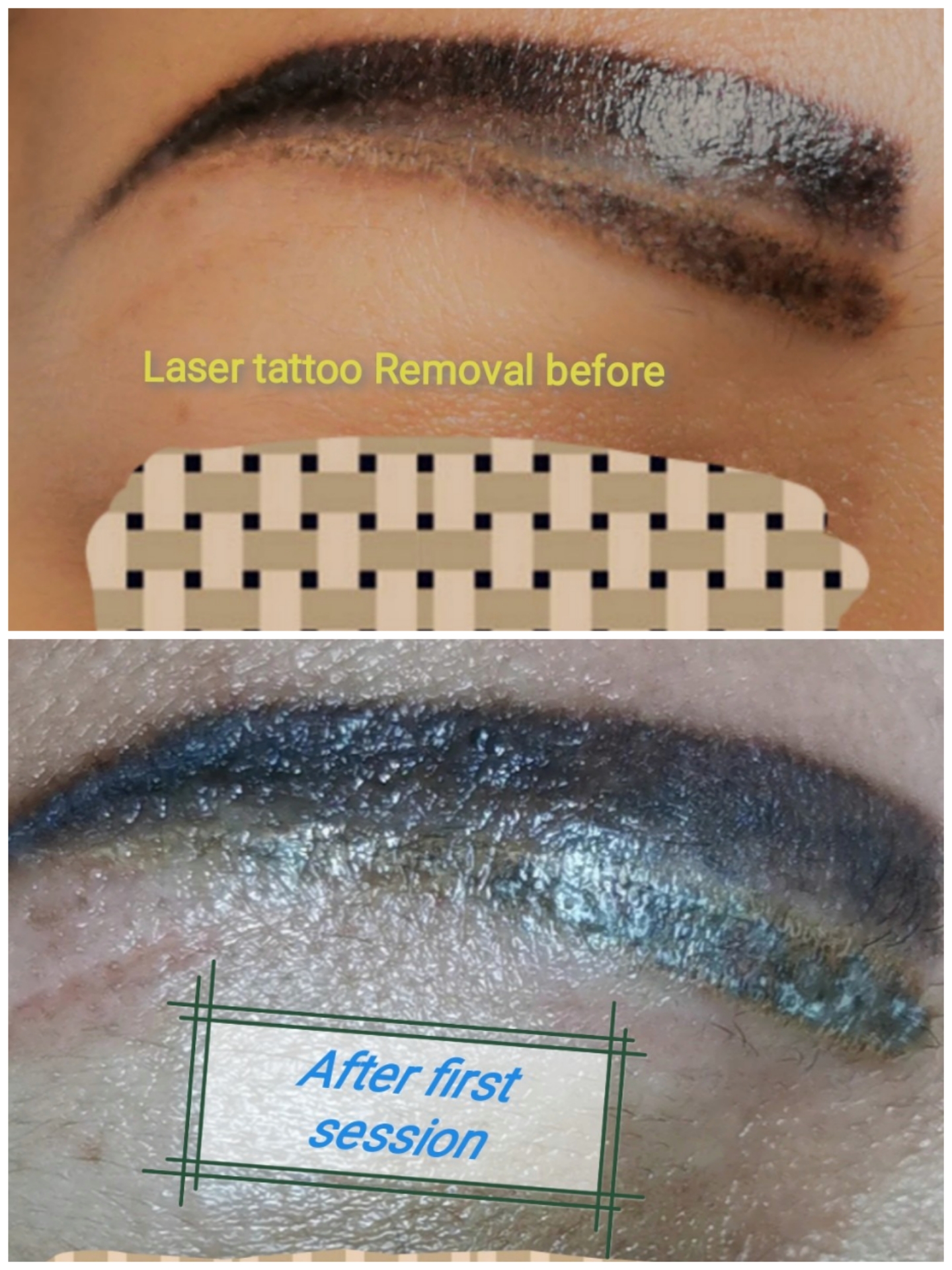 Laser tattoo removal treatment in Worcestershire  Outline Clinic Droitwich